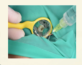 歐羅德卡ONE-PLEX-上頜前磨牙彎曲根管治療